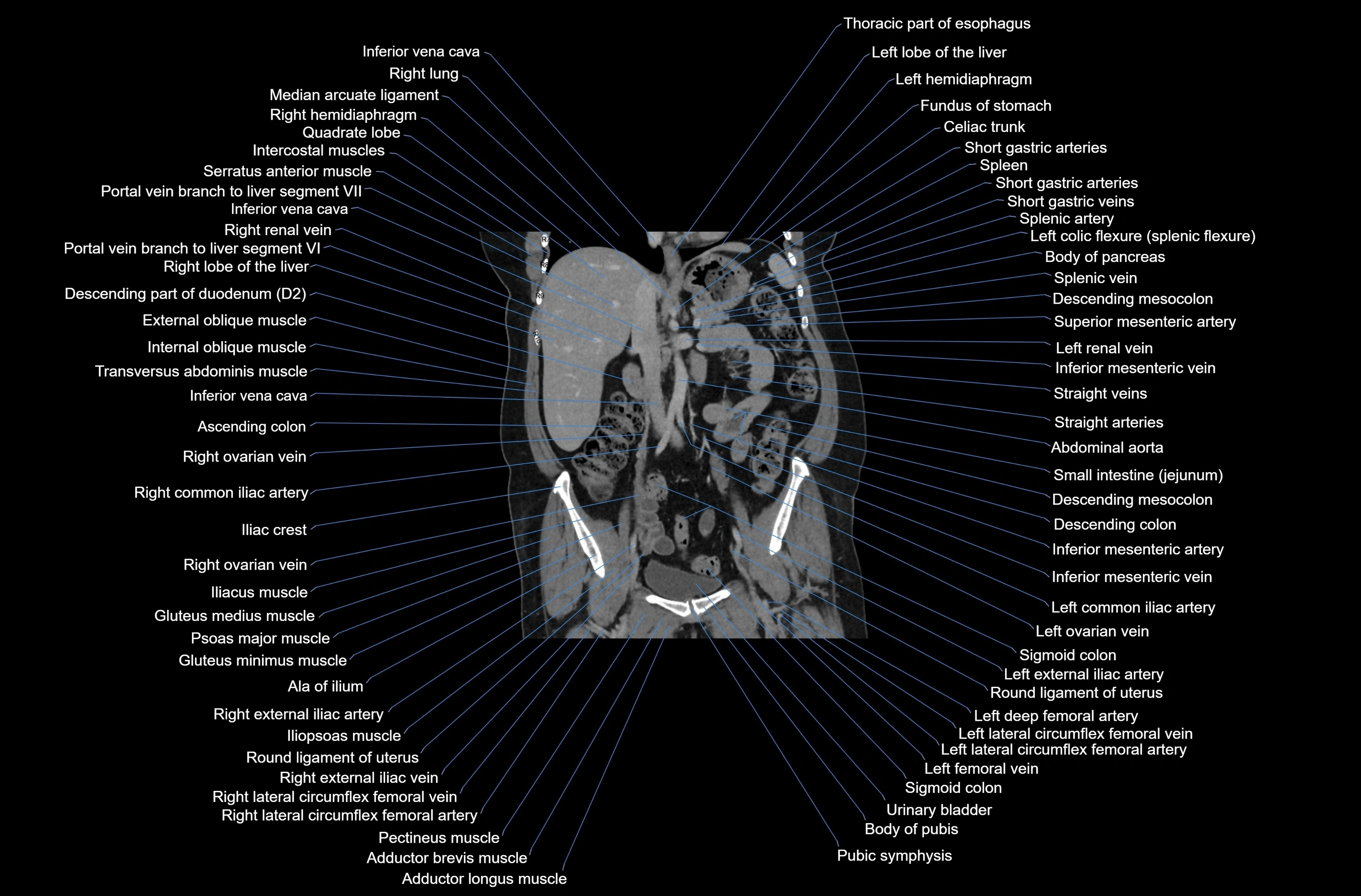 CT abdomen coronal cross sectional anatomy labelled radiology image-00044.webp
